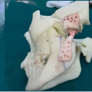 Cutting edge 3D skull model aids jaw lock surgery for cancer survivor